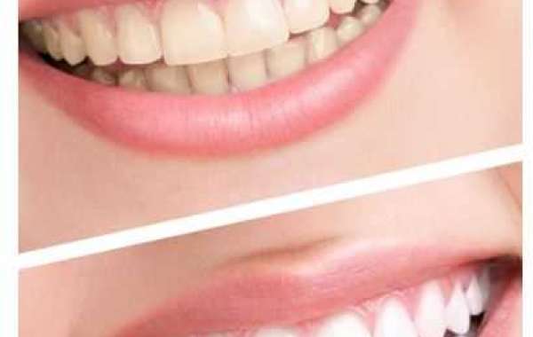 What Is the Most Effective Teeth Whitening Method?